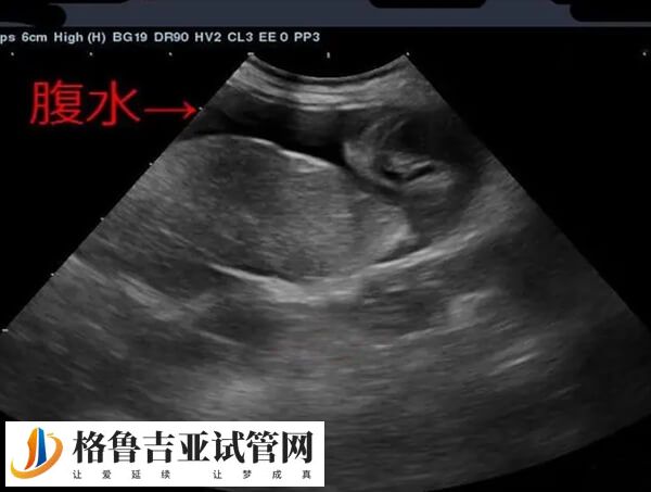 取卵后腹水症状有哪些